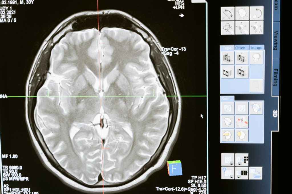 Traumatic Brain Injuries